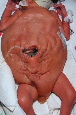 Newborn With Wrinkled Abdomen and Other Anomalies