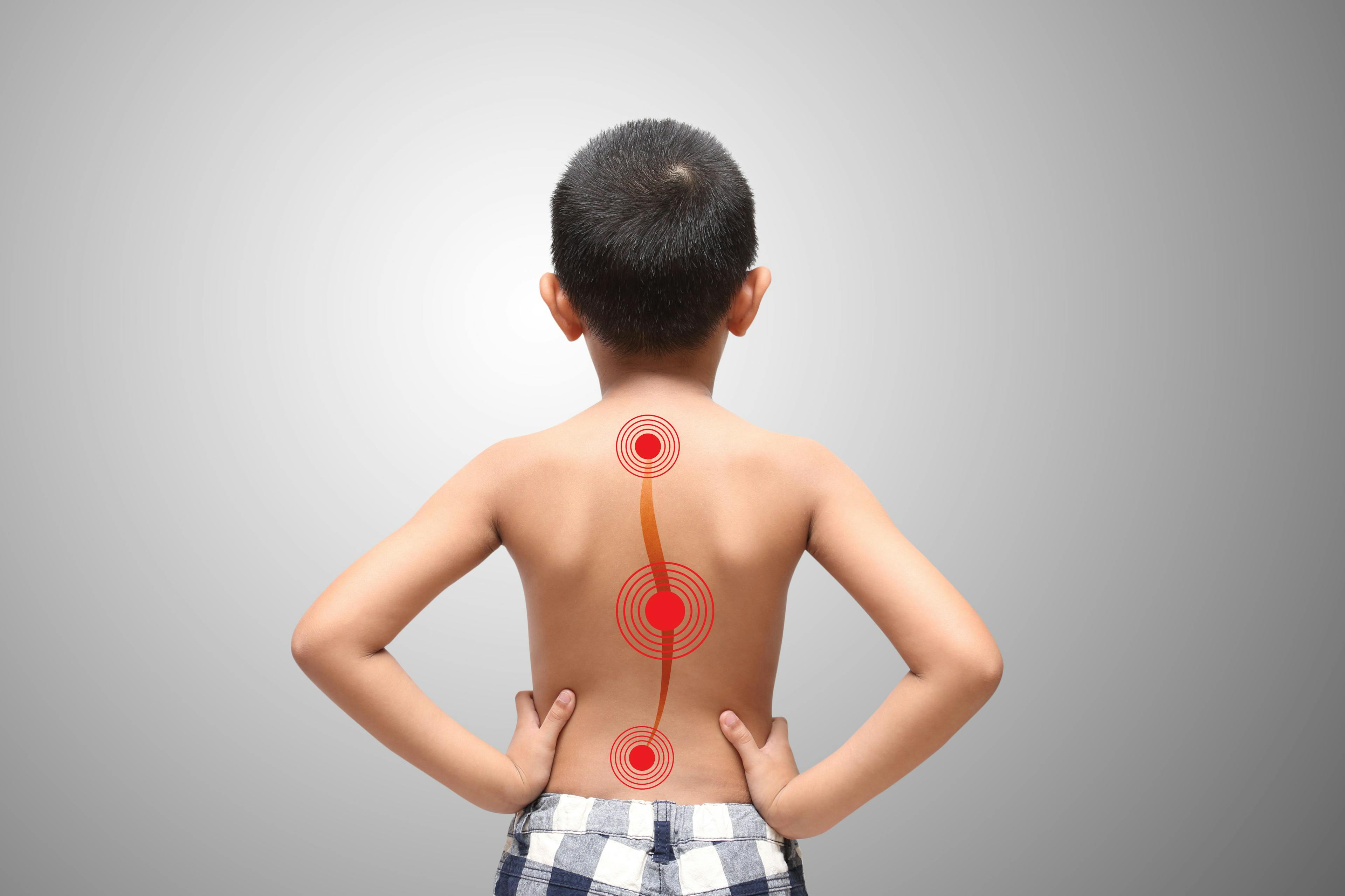 Model more accurate for predicting adolescent idiopathic scoliosis than physicians | Image Credit: © jeffy1139 - © jeffy1139 - stock.adobe.com.