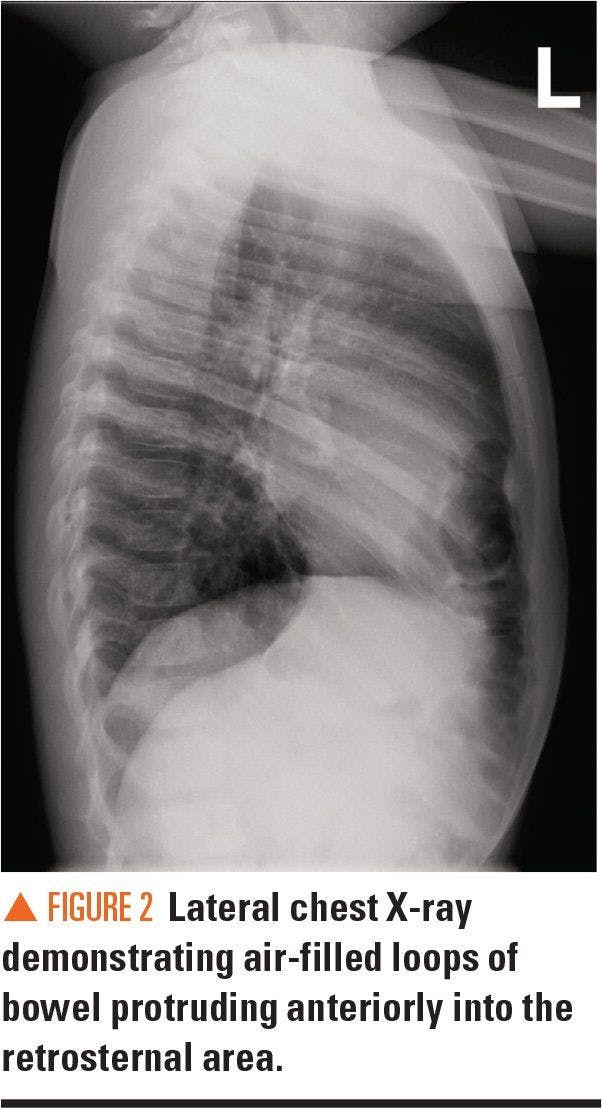 Lateral chest X-ray demonstrating air filled loops of bowel protruding anteriorly into the retrosternal area.