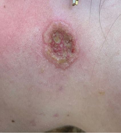 Figure 3. Solitary ulcerated lesion on the right cheek. (Image provided by author)