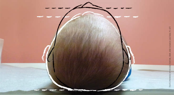 A pediatric epidemic: Deformational plagiocephaly/brachycephaly and congenital muscular torticollis
