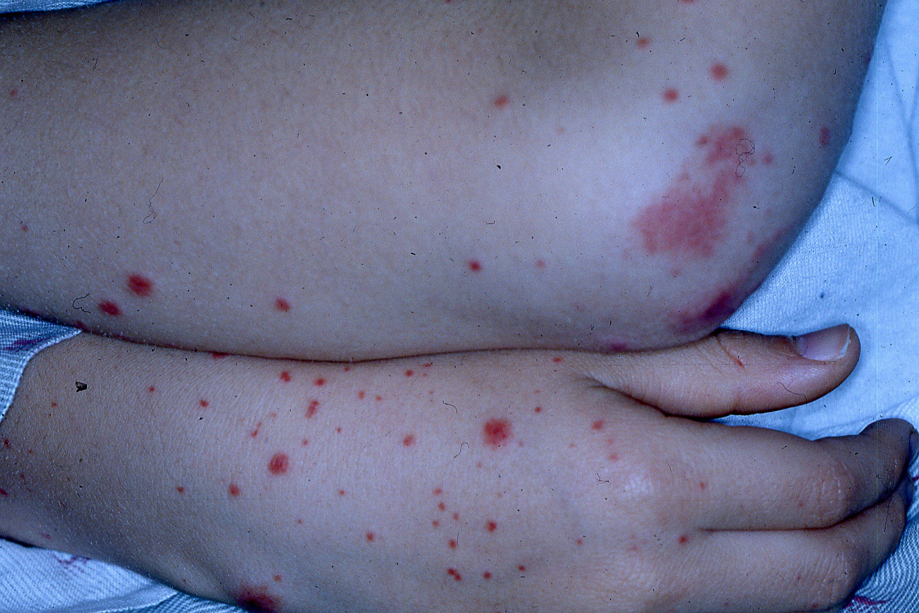 Purpuric papules in a child with acute pancreatitis
