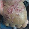 Toddler With Nonpruritic Rash That Does Not Respond to Corticosteroids