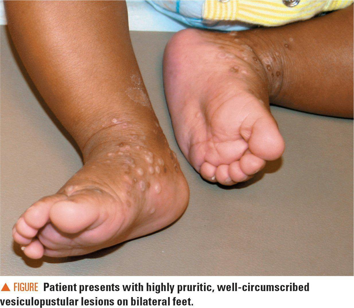 Patient presents with highly pruritic, well-circumscribed vesiculopustular lesions on bilateral feet