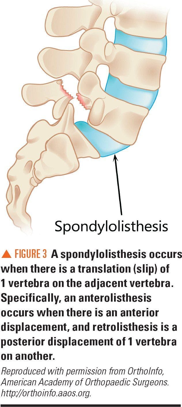 image showing spondylolisthesis