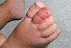 Swollen Red Toe: Child Abuse-or Mimic?