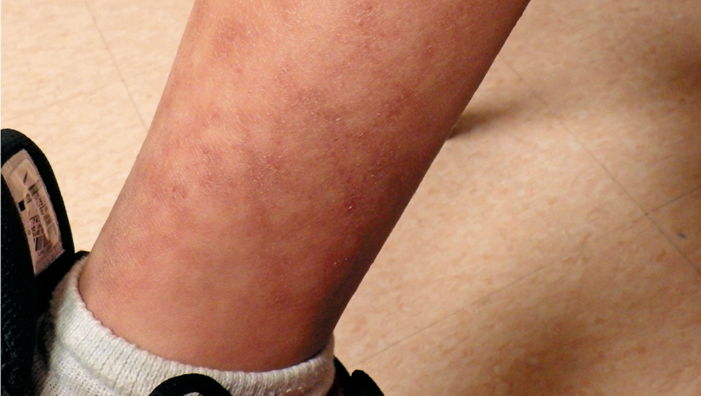 Reticulated rash on boy’s lower extremities