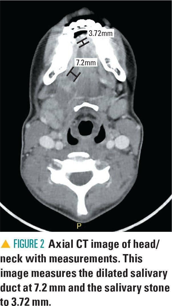 Axial CT image of head/neck with measurements