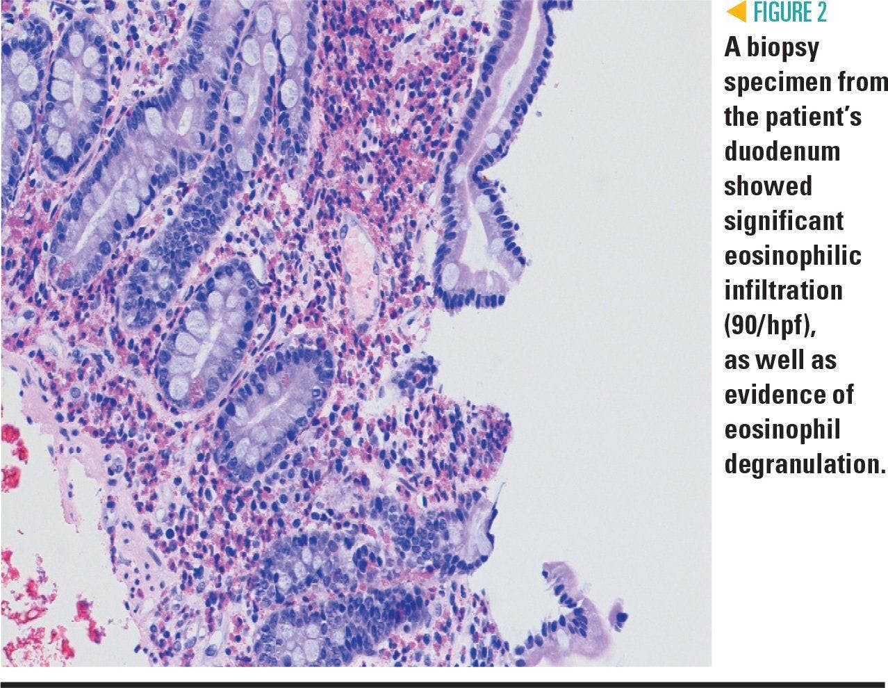 A biopsy of a specimen taken from the patient's duodenum