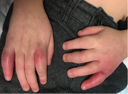 Four-year-old with itchy, red, painful hands following snow exposure