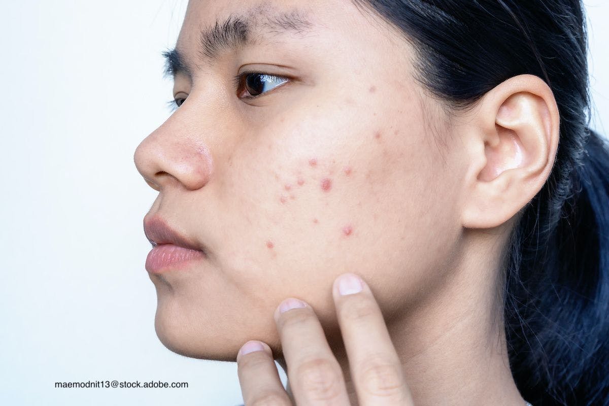 Pearls for acne in skin of color