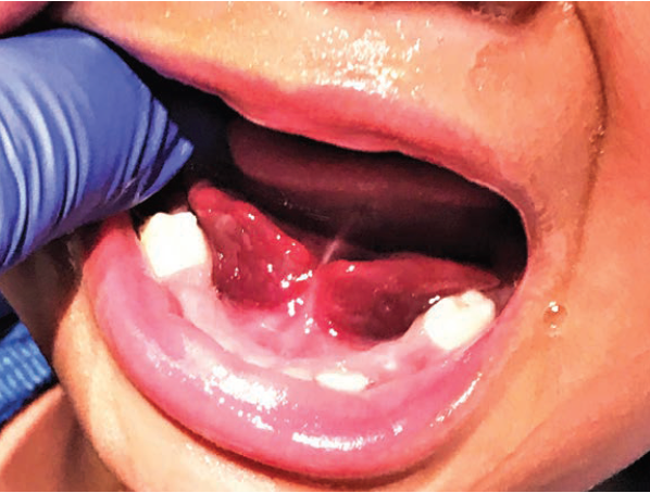 patient's mouth