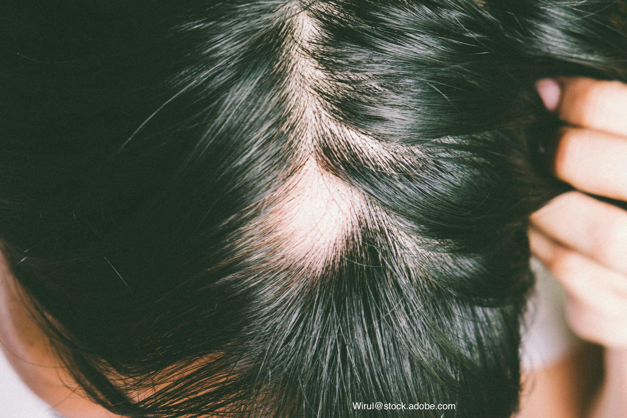 Determining the incidence and prevalence of alopecia areata