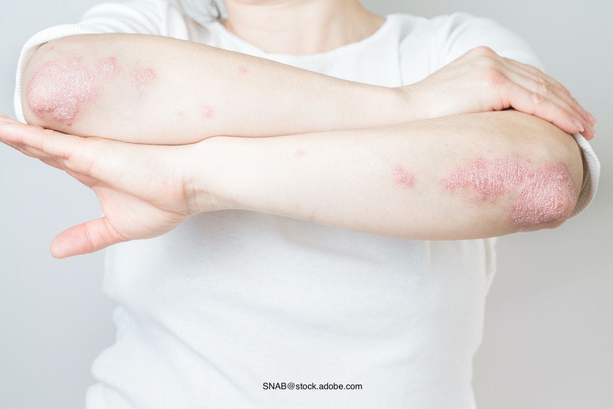 Halobetasol propionate foam approved for treatment of plaque psoriasis in teens