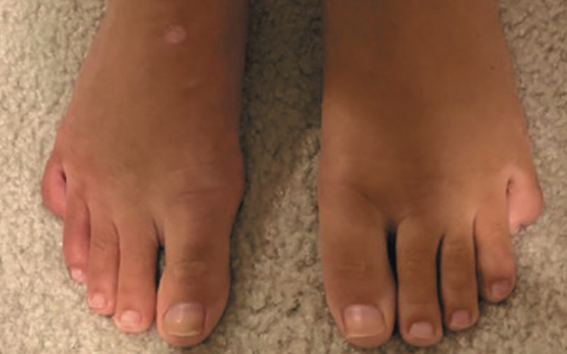 Persistent foot and leg swelling in a 17-year-old female