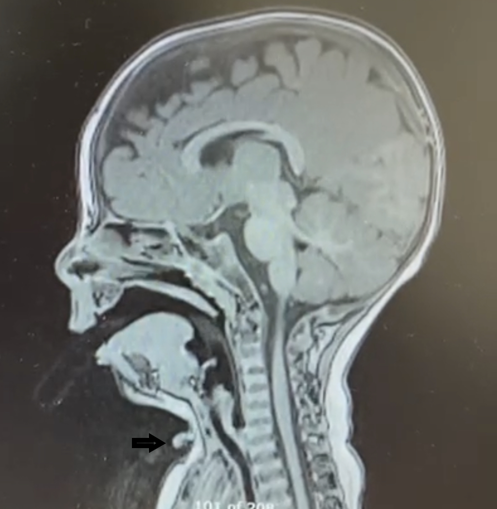 (Figure 3)

Sagittal T2 -weighted MRI image of the patient showing midline cervical cleft on vental side (Black arrow).