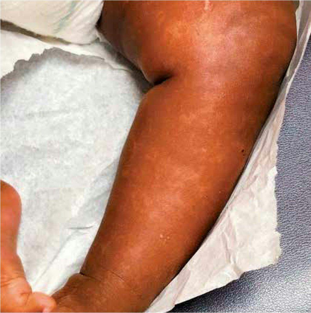 Figure 1. Streaky hypopigmentation is characteristic of pigmentary mosaicism 
