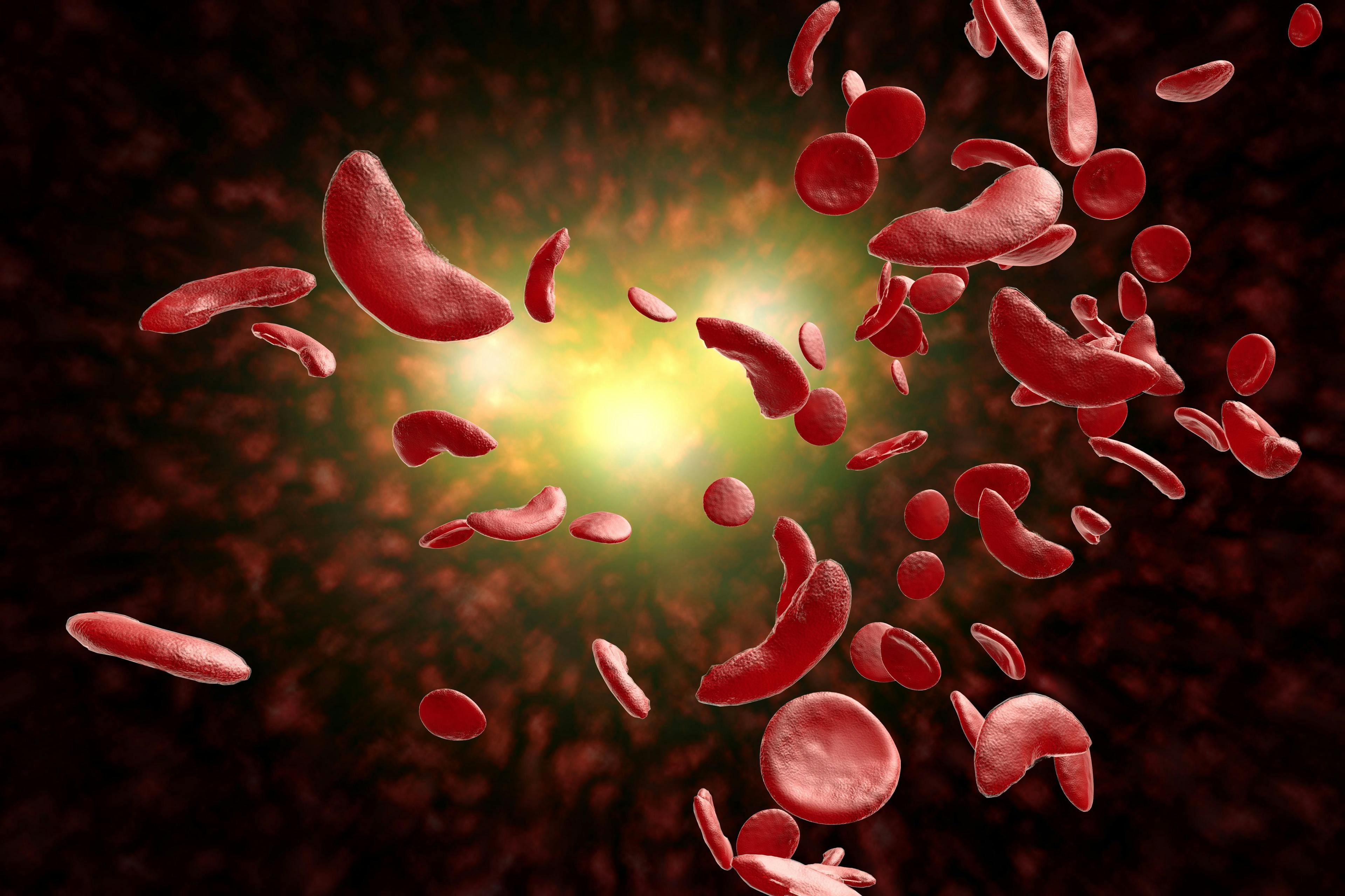 Sickle cell anemia | Image Credit: © Ezume Images - © Ezume Images - stock.adobe.com.