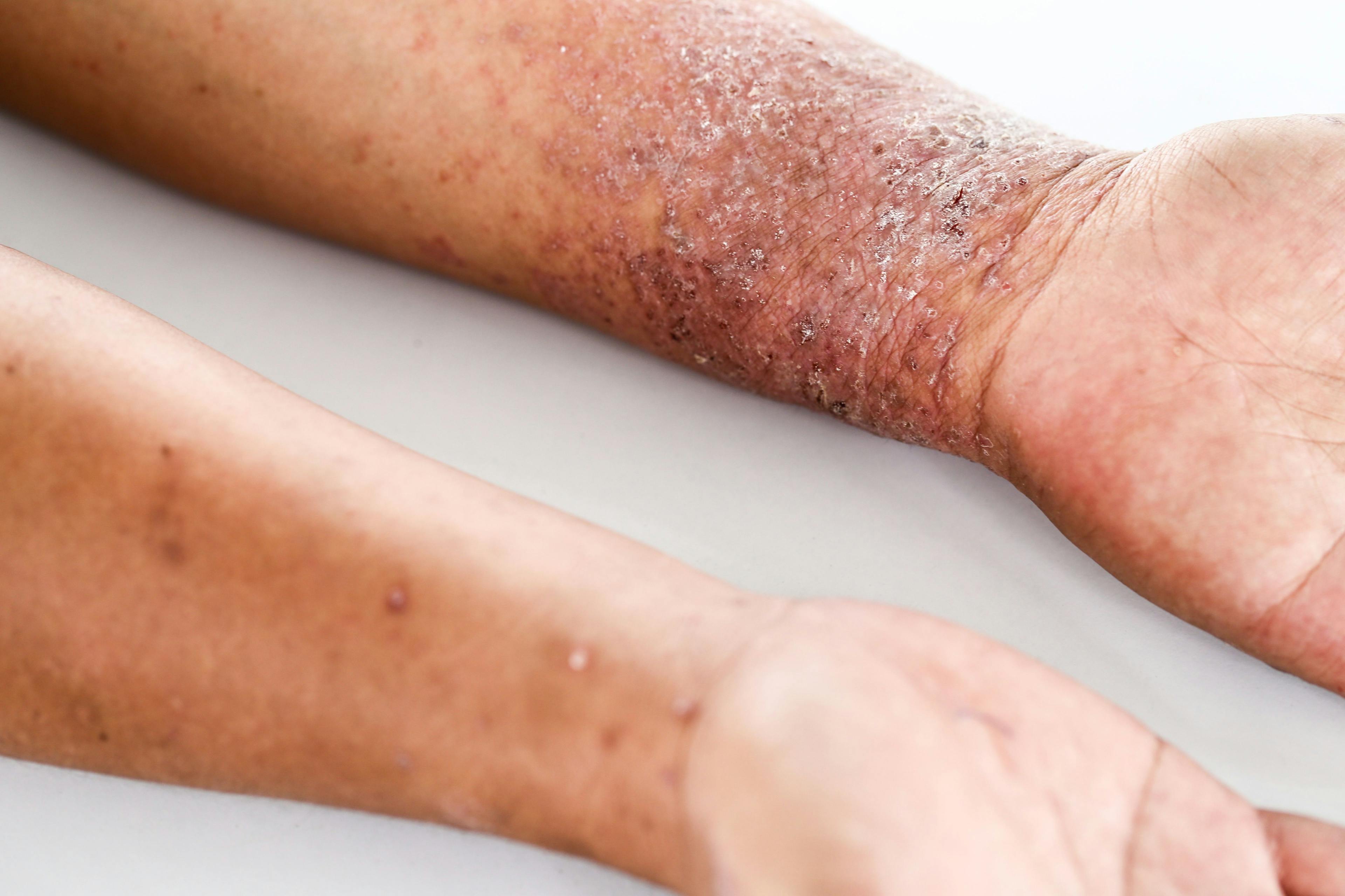 Dupilumab effective against atopic dermatitis regardless of age-of-onset 