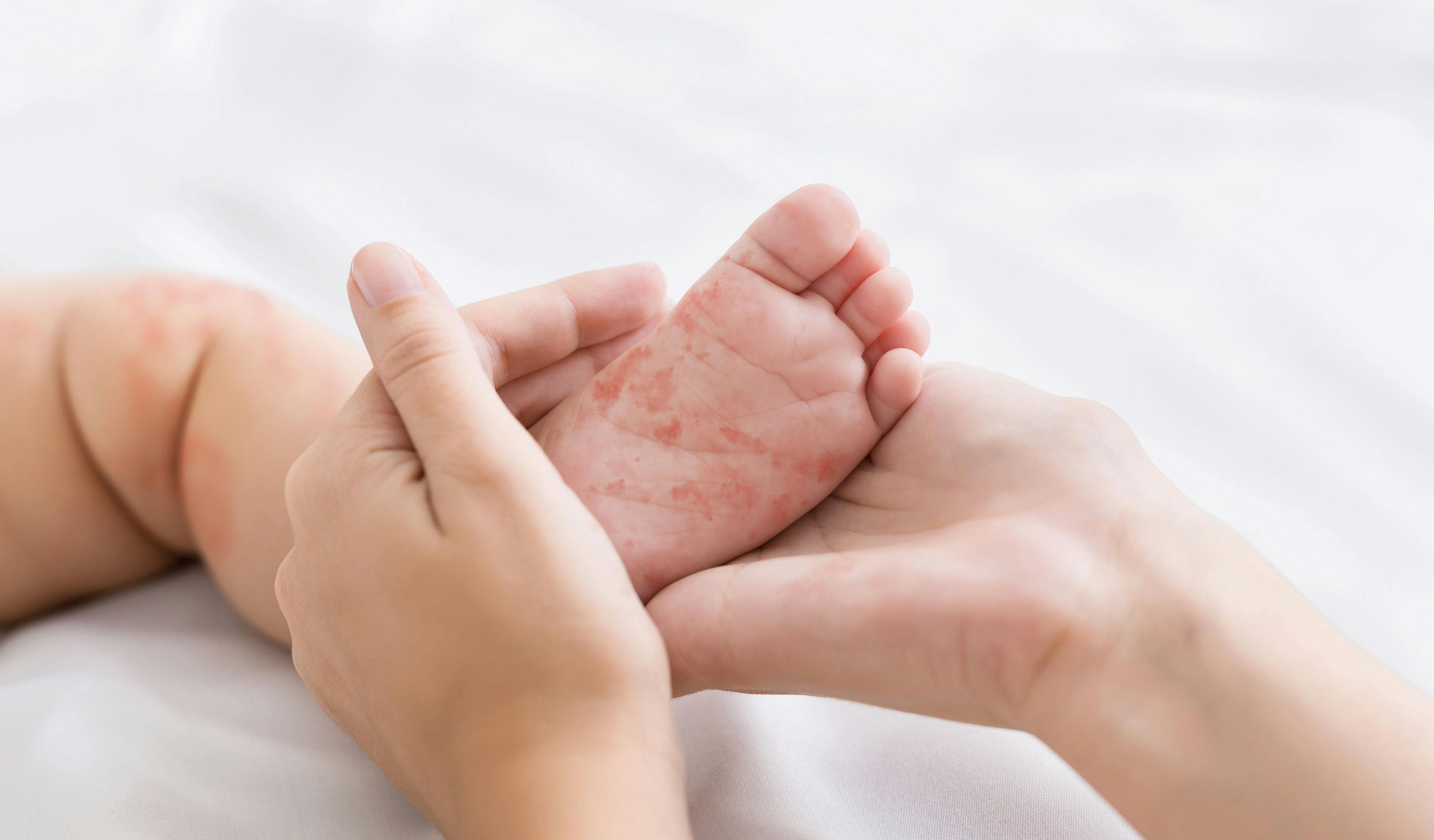 Children at greater risk of measles infection