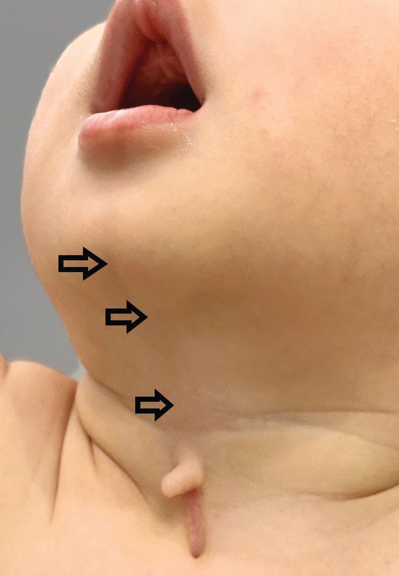 (Figure 2) 

Neck extension produces webbing of the skin between the cleft and the mandible (black arrow).