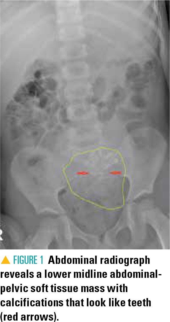 Abdominal radiograph revealing a pelvic soft tissue mass with calcifications