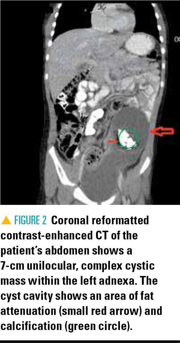 CT showing patient's abdomen