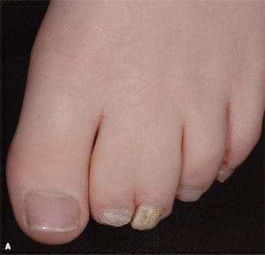 Two girls present with toenail yellowing and thickening