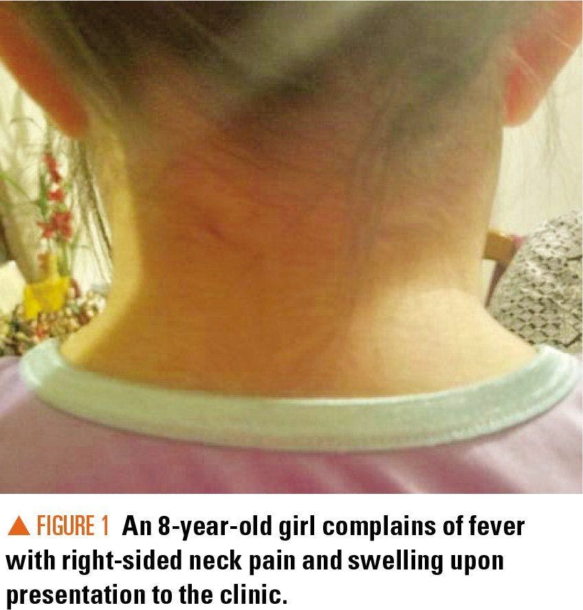 8-year-old girl with swelling on the right side of her neck