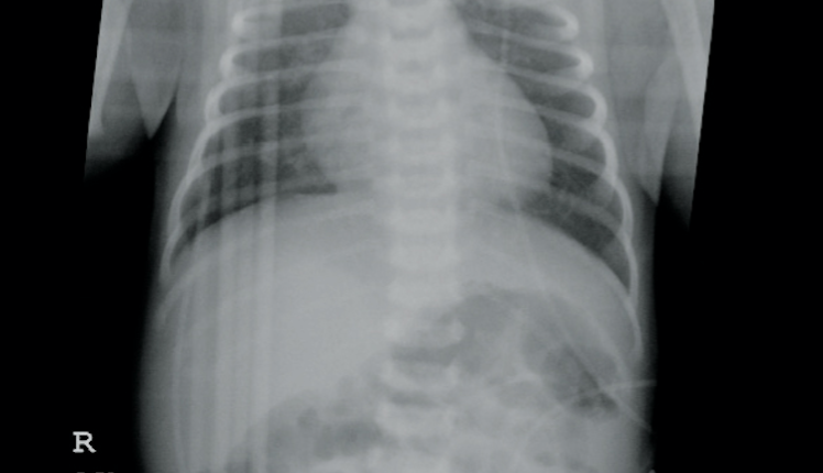 image of infant with IUGR and emesis