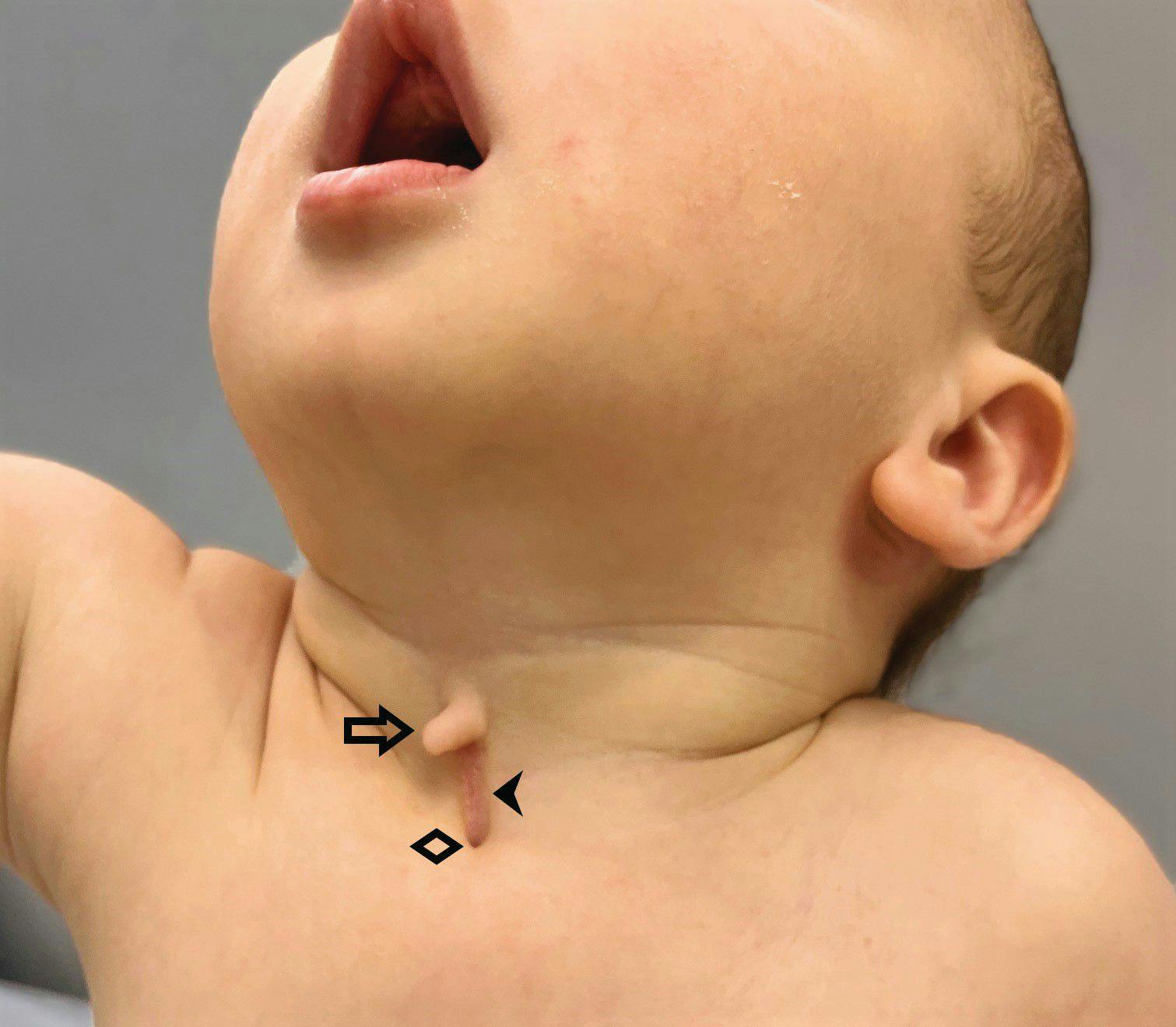 Newborn with midline neck lesion | Image Credit: Author provided