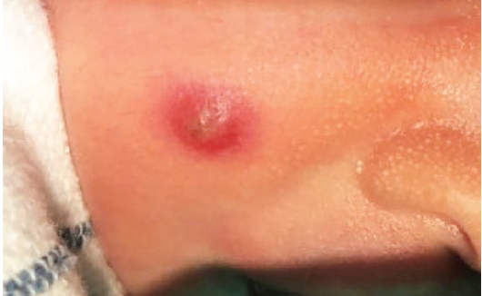  Red papulonodule with central crusting on a neonate’s cheek