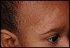 What About This Light-Colored Patch Over an Infant’s Brow Rules Out Vitiligo?