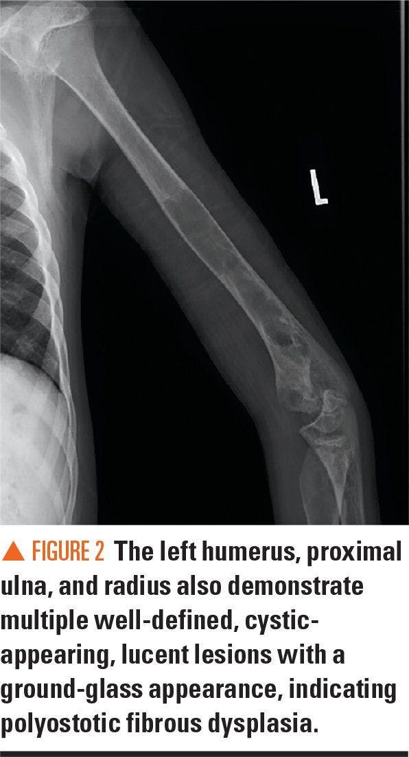Left humerus, proximal ulna, and radius showing lucent lesions indicating polyostic fibrous dysplasia