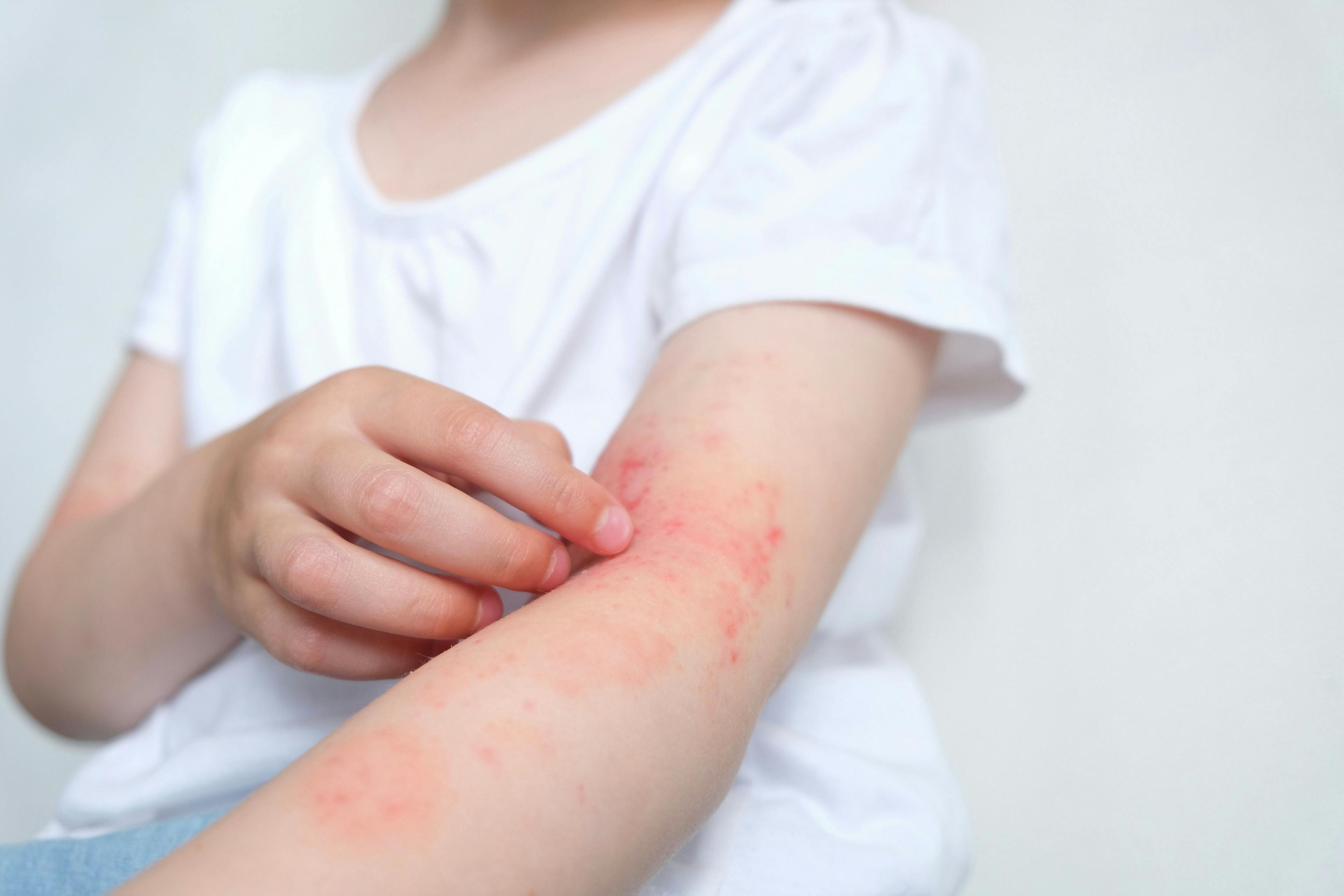 Child scratching skin | Image Credit: © Марина Терехова - © Марина Терехова- stock.adobe.com.
