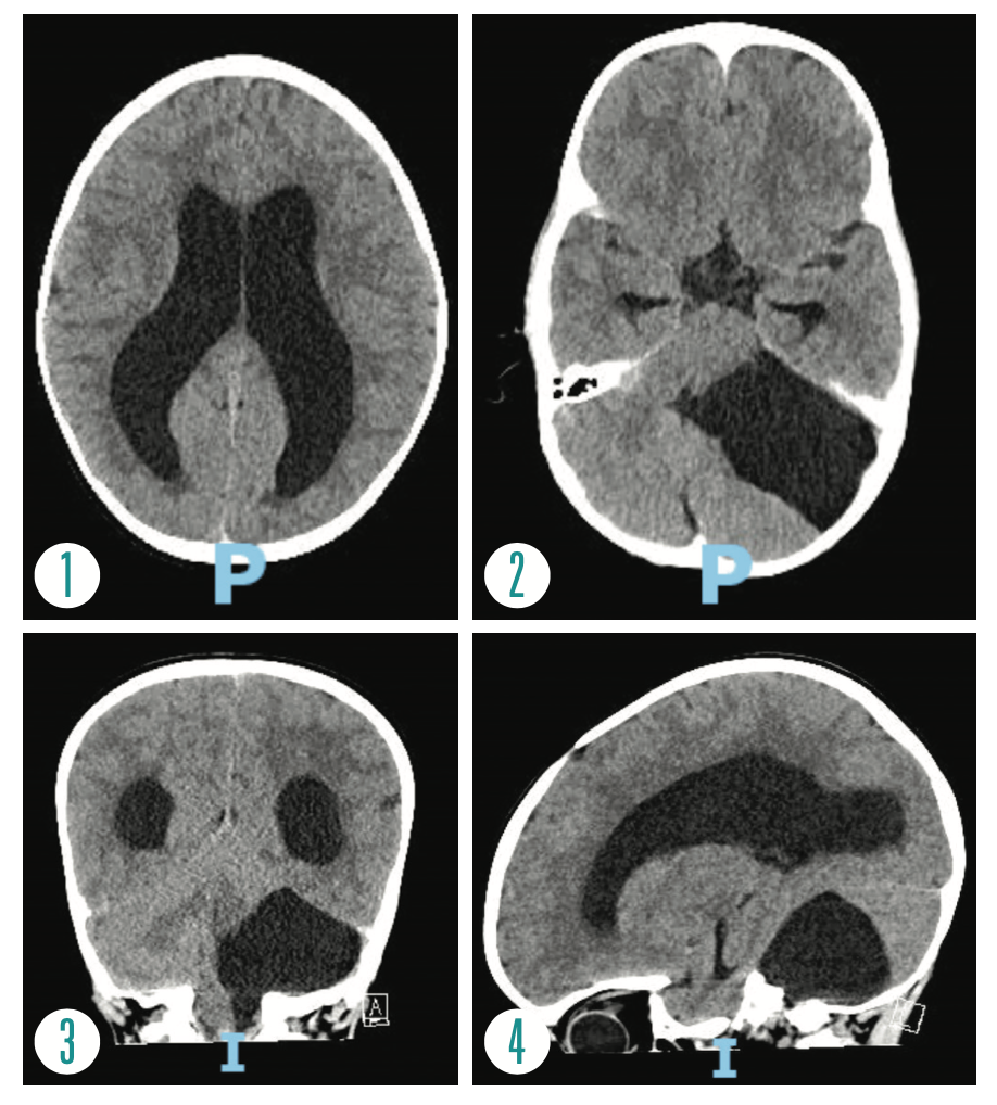 FIGURE 1. CT of the head, axial view, demonstrates moderate to marked enlargement of the bilateral lateral ventricles compatible with hydrocephalus.

FIGURE 2. CT of the head, axial view, demonstrates a 5.8 × 3.9× 4.4-cm cyst present in the left aspect of the posterior fossa anterior and lateral to the left cerebellar hemisphere.

FIGURE 3. CT of the head, coronal view, demonstrates a 5.8 × 3.9 × 4.4-cm cyst present in the left aspect of the posterior fossa anterior and lateral to the left cerebellar hemisphere.

FIGURE 4. CT of the head, sagittal view, demonstrates a 5.8 × 3.9 × 4.4-cm cyst present in the left aspect of the posterior fossa anterior and lateral to the left cerebellar hemisphere.

CT HEAD FINDINGS

A 5.8 × 3.9 × 4.4cm cyst isodense to CSF is present in the left aspect of the posterior fossa anterior and lateral to the left cerebellar hemisphere. There is moderate to marked enlargement of the bilateral, lateral, and third ventricles compatible with hydrocephalus. The fourth ventricle is normal in size. There is mild scalloping of the occipital bone, and the cyst appears to communicate with the inferiormost aspect of the fourth ventricle/foramen of Magendie. There is an associated mass effect on the dorsal aspect of the brainstem and left cerebellar hemisphere, with partial effacement and rightward deviation of the fourth ventricle. The findings are compatible with a posterior fossa arachnoid cyst demonstrating local regional mass effect and resultant moderate to marked supratentorial hydrocephalus.