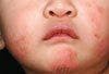 What Caused the Facial Rash in These Infants That Resists All Topical Therapies?