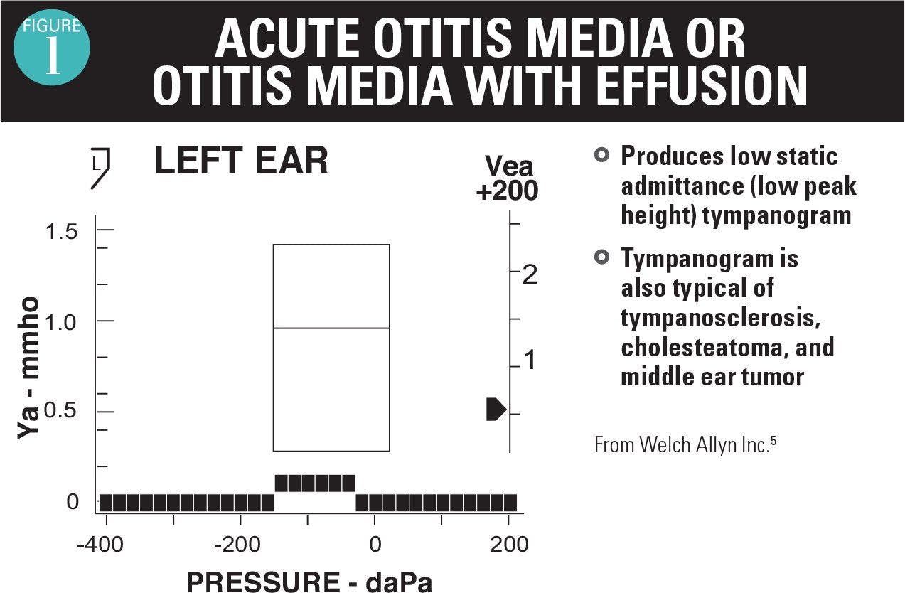 Acute otitis media or otitis media with effusion