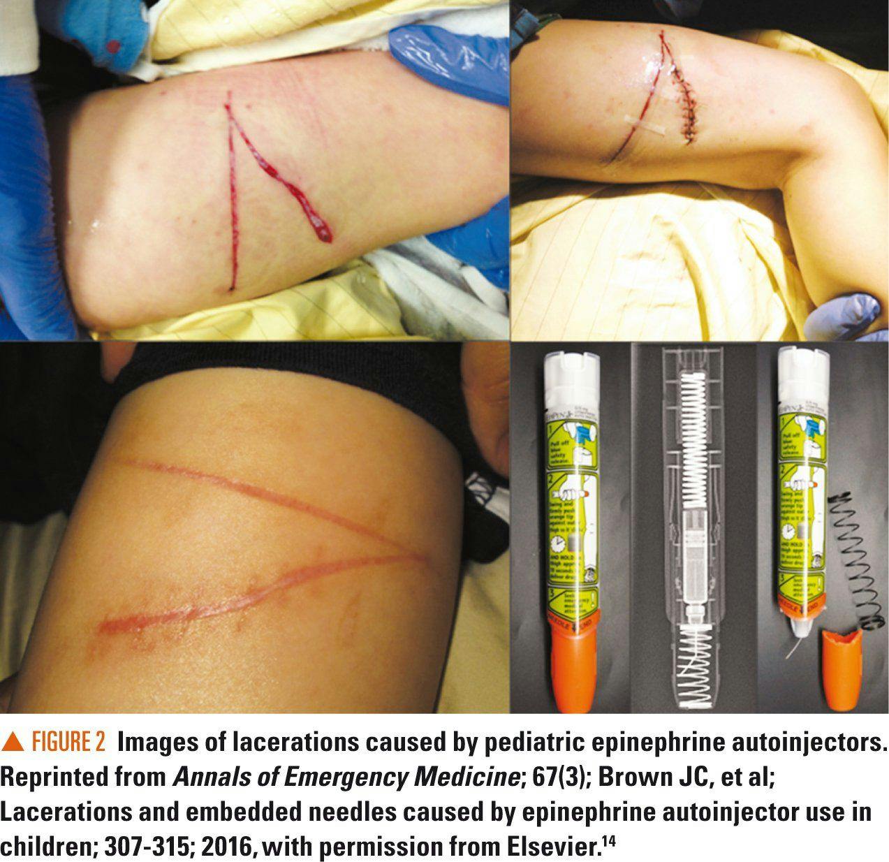 Images of lacerations caused by autoinjectors
