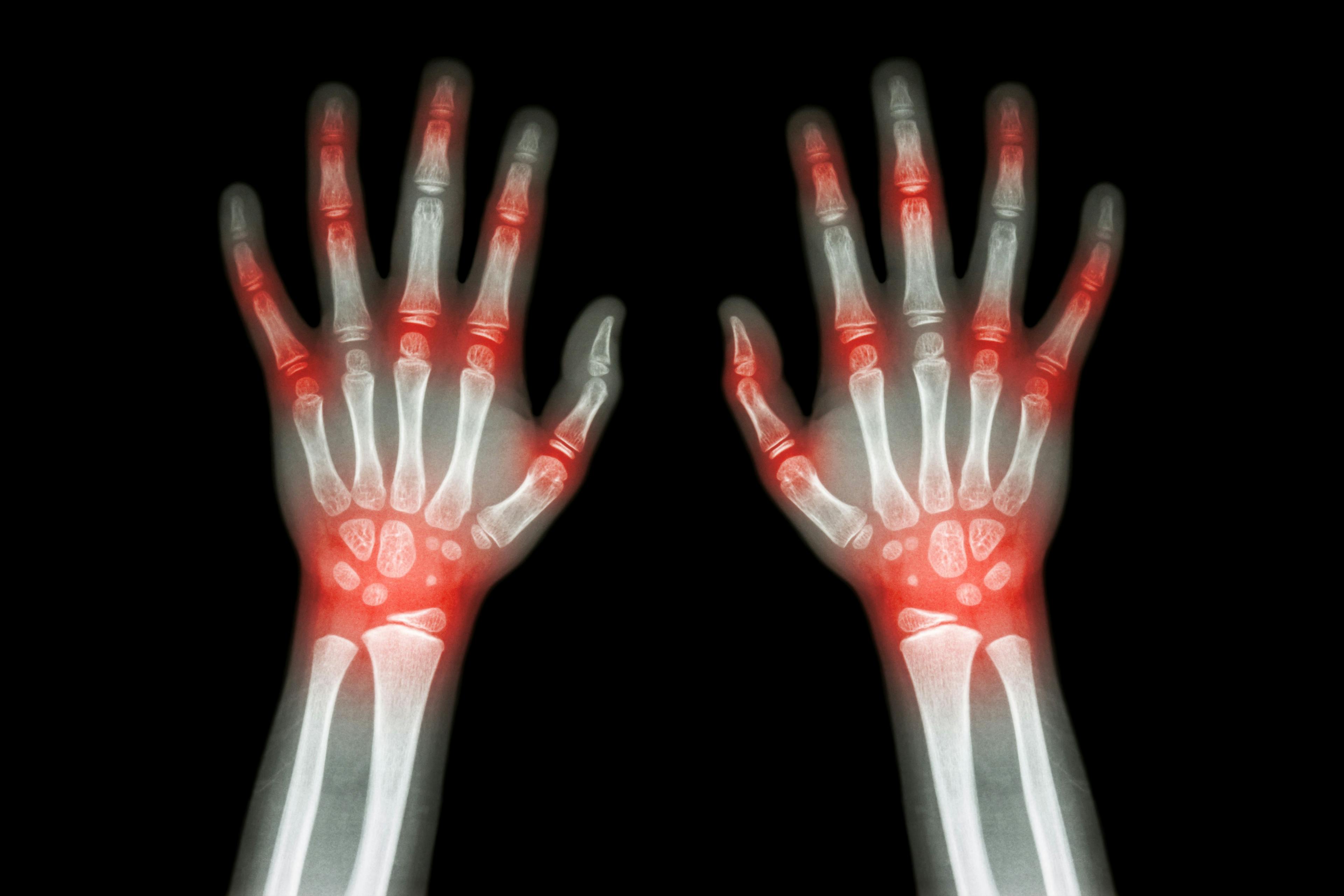 Familial autoimmune diseases linked to pediatric juvenile idiopathic arthritis