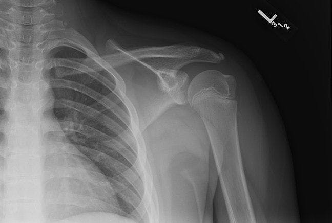 Shoulder x-ray - anteroposterior view