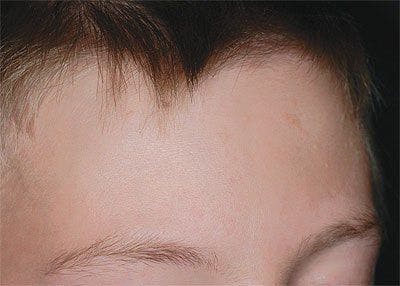 How can these forehead lesions be managed without risk of scarring?